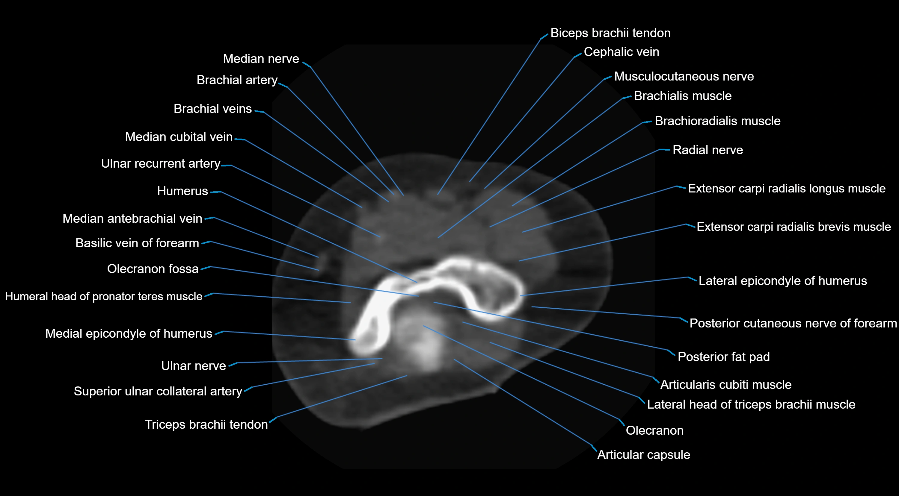 CT elbow axial  cross sectional anatomy labelled  radiology image -00015.webp